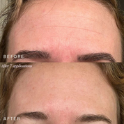 Reusable Forehead Patch