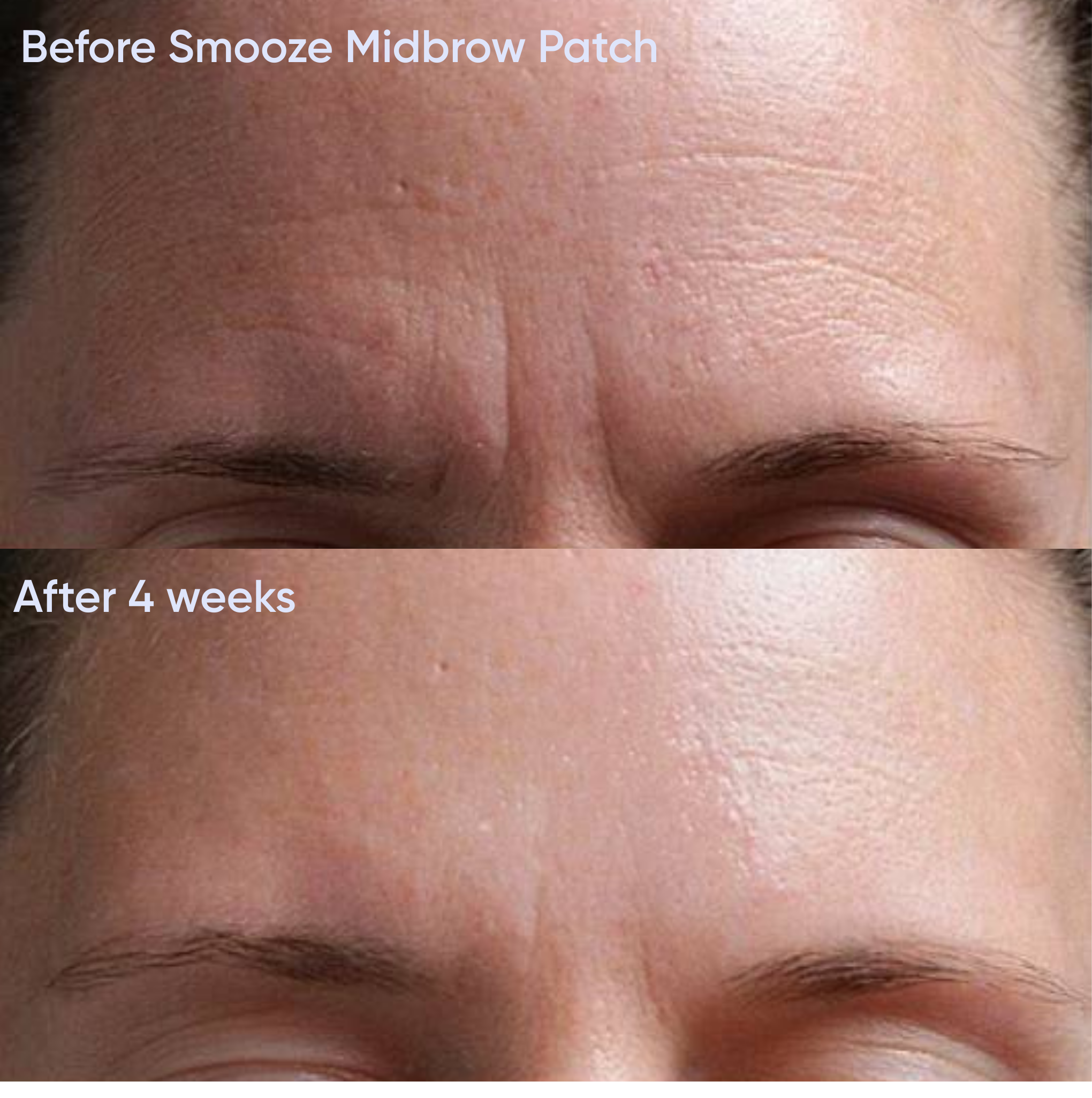 Reusable Mid Brow Lift Patch x2