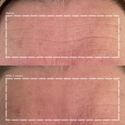 Reusable Forehead Wrinkle Smoothing Patch