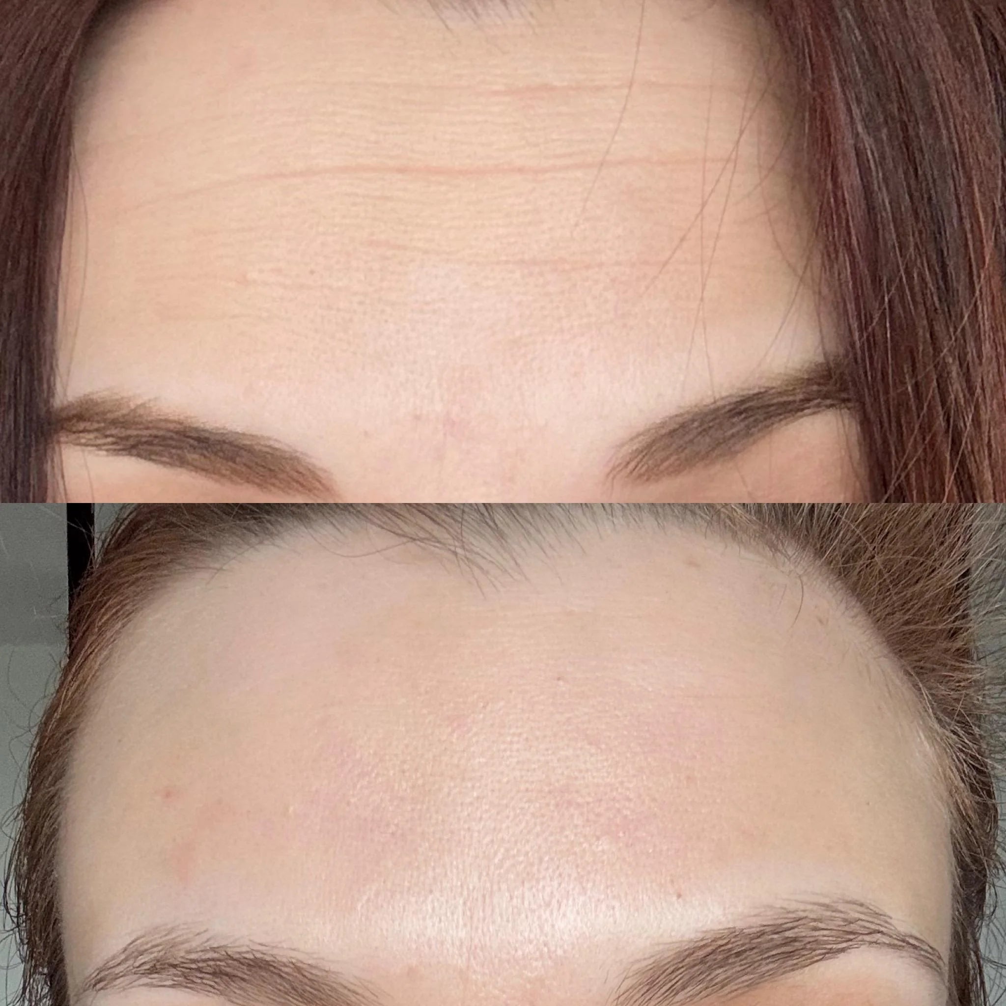 forehead-wrinkles-before-after-9-months-progress-v0-t940o7tw0eff1_1.webp